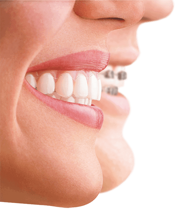 Two people smiling with clear aligners and braces