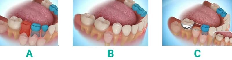 why treat a decayed milk tooth 1 drifting of the tooth behind extraction space