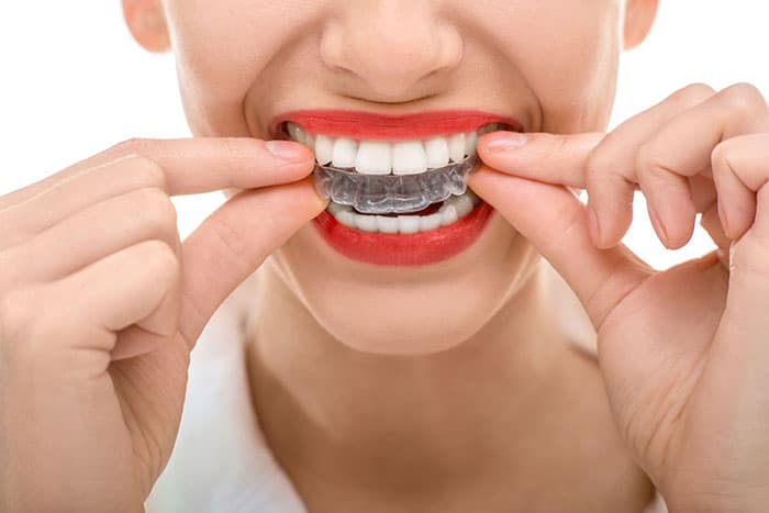 Smiling Girl Wearing Clear Aligners