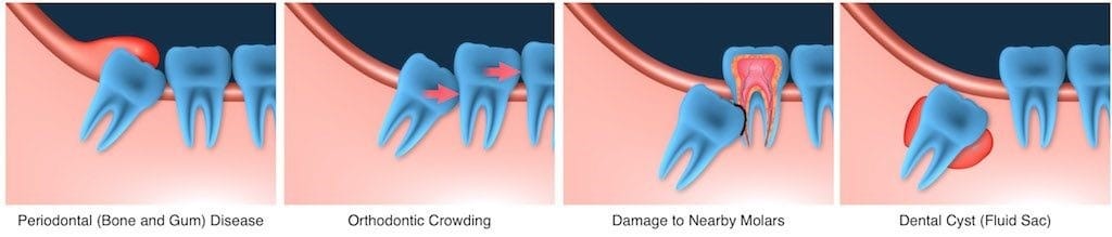 problems with erupting wisdom teeth