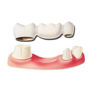 Bridge - Dental Treatment Speciality at Smile Mantra Dental and Cosmetic Clinic