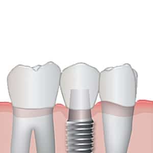 Implant - Dental Treatment Speciality at Smile Mantra Dental and Cosmetic Clinic