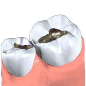 Inlays - Dental Treatment Speciality at Smile Mantra Dental and Cosmetic Clinic