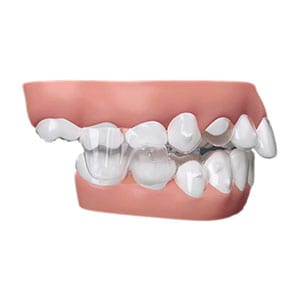 Invisalign - Dental Treatment Speciality at Smile Mantra Dental and Cosmetic Clinic