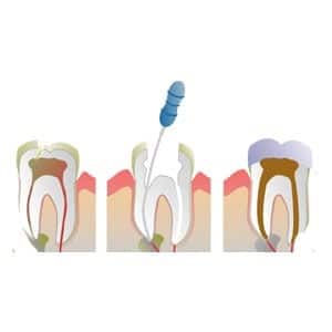 Root Canal - Dental Treatment Speciality at Smile Mantra Dental and Cosmetic Clinic