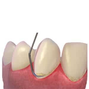 Scaling - Dental Treatment Speciality at Smile Mantra Dental and Cosmetic Clinic