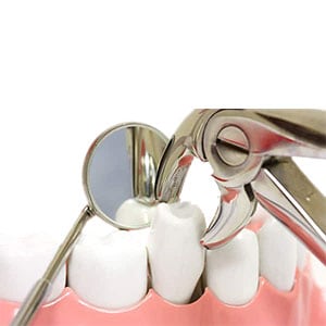 Tooth Extractions - Dental Treatment Speciality at Smile Mantra Dental and Cosmetic Clinic