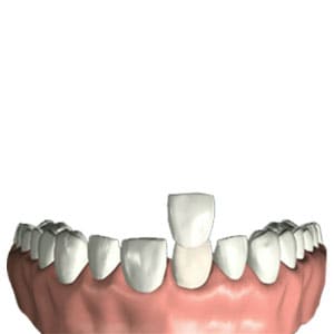 Veneer - Dental Treatment Speciality at Smile Mantra Dental and Cosmetic Clinic