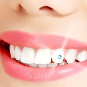 Tooth Jewellery - Dental Treatment Speciality at Smile Mantra Dental and Cosmetic Clinic
