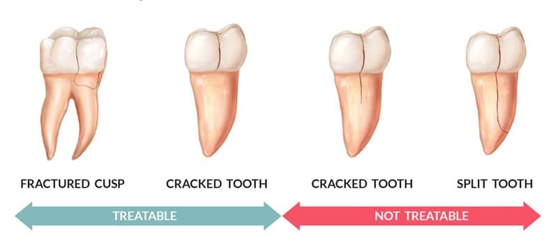 treatable and non treatable cracked tooth